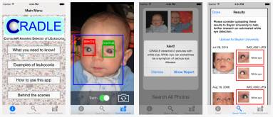 CRADLE application can detect EYE Cancer with photos in children